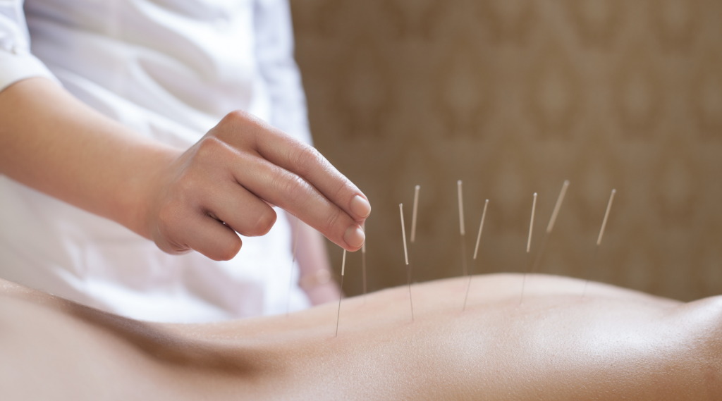 acupuncture in Santa Rosa California